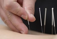 acupuncture st helens 726287 Image 0